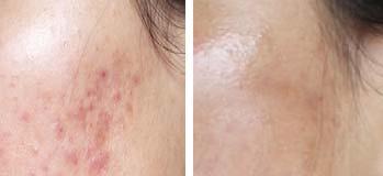 Dermal Peel Treatments